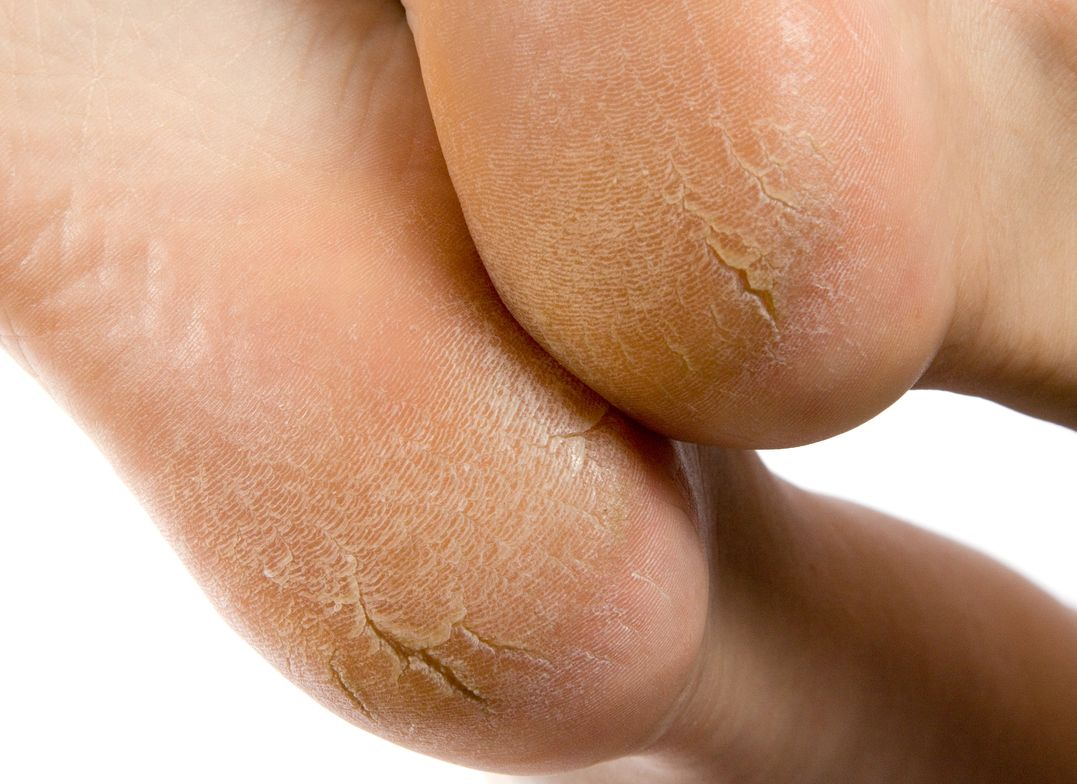 Berikut ini penyebab kapalan yang sering muncul di kaki dan tangan, salah satunya karena pakai sepatu tidak sesuai ukuran.