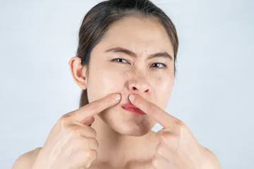 Bahan aktif untuk mengatasi jerawat