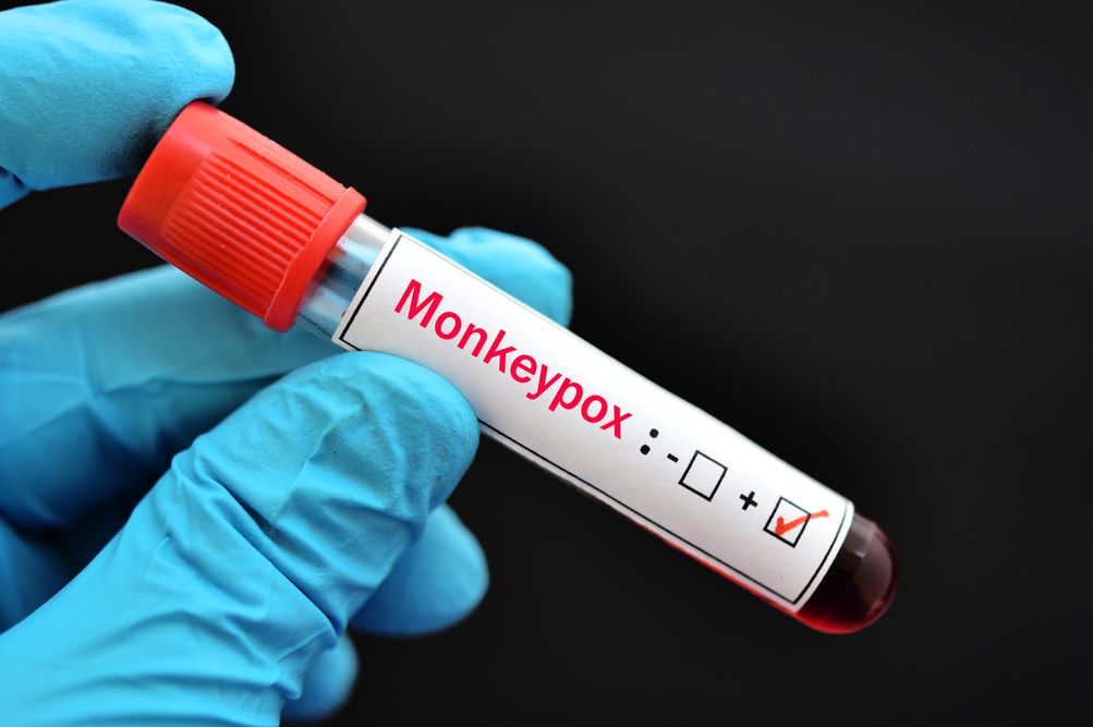 Kasus baru cacar monyet atau monkeypox ditemukan di Tangerang Selatan. Begini upaya mencegah cacar monyet menurut Kemenkes.