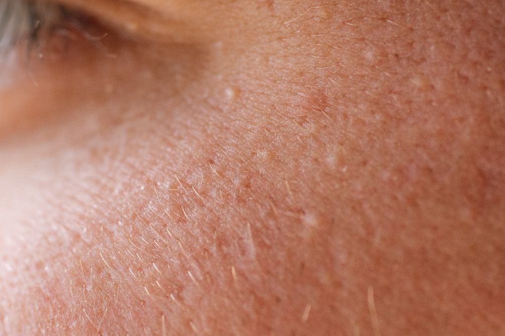 Dokter estetika menjelaskan penyebab hingga cara mengatasi milia dengan menggunakan skincare berkandungan eksfoliatif.