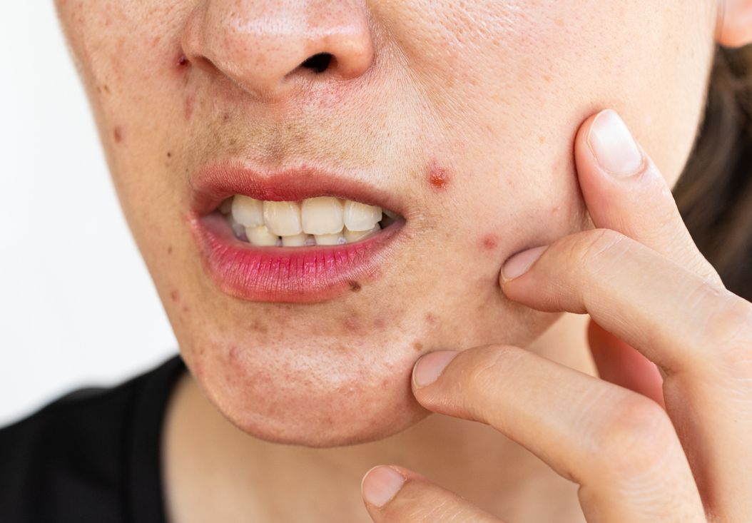 Menyambut Acne Awareness Month, yuk ketahui 4 cara mengatasi acne mechanica yakni jerawat yang timbul akibat gesekan.