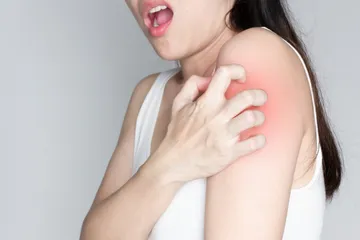 Tips merawat kulit eksim