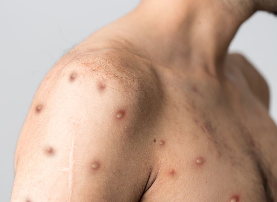 Understanding Monkey Pox: Symptoms, Transmission, and Prevention