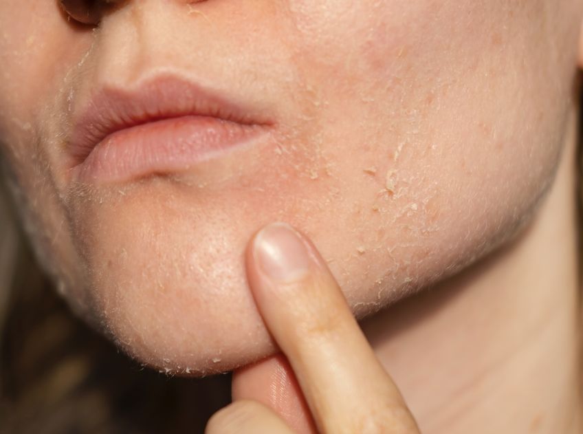 Viral di TikTok, berikut ini penjelasan dokter tentang basic skincare untuk menyembuhkan kulit yang rusak akibat krim abal-abal.