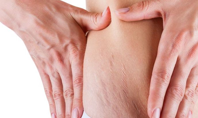 Mengalami gurat peregangan di daerah perut, paha, atau pantat apakah tanda munculnya stretch mark? Yuk, kita ketahui fakta tentang stretch mark ini.