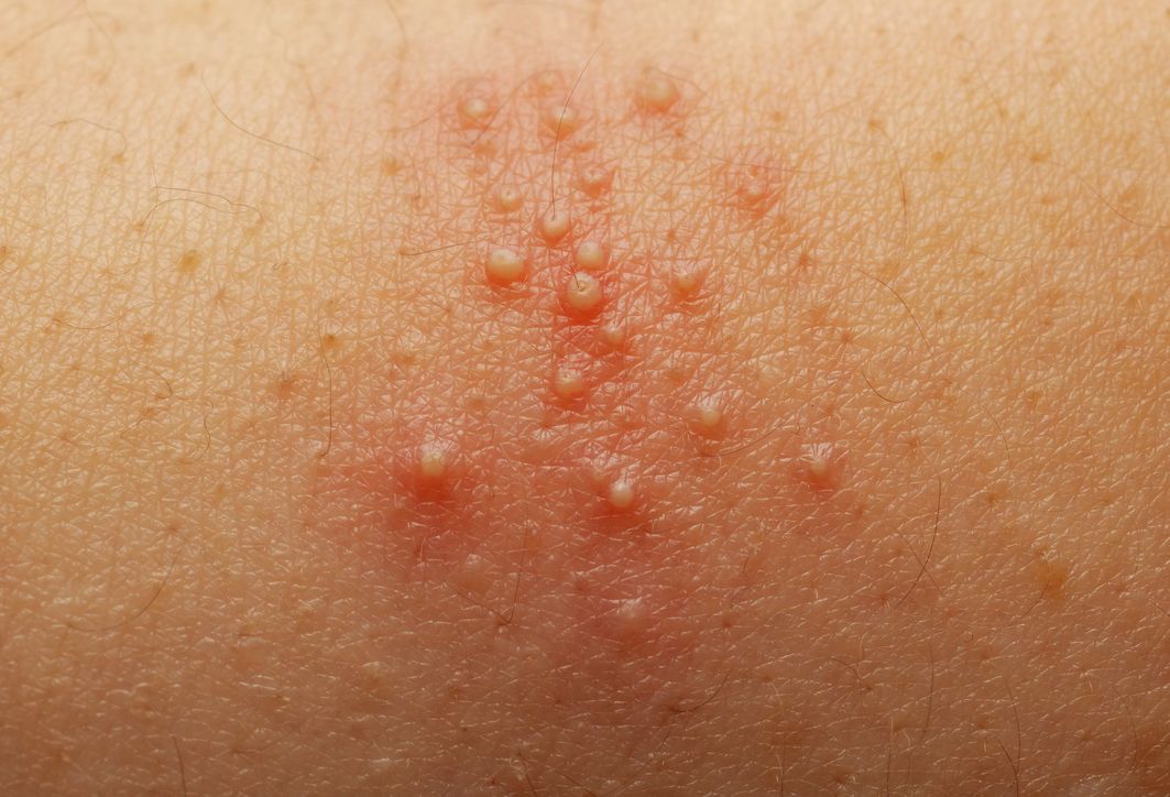 Berikut ini penyebab fungal acne, kondisi kulit yang viral di TikTok, namun bukan jerawat biasa, simak selengkapnya.
