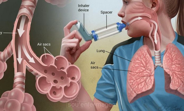 Bagi Kawan Puan yang merupakan penderita asma, yuk sebaiknya kamu mengikuti 8 tips self-care ini, supaya kamu siap saat asma kambuh