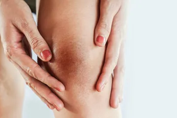 Tips merawat lutut kaki.