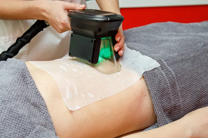 Prosedur CoolSculpting yang viral di TikTok