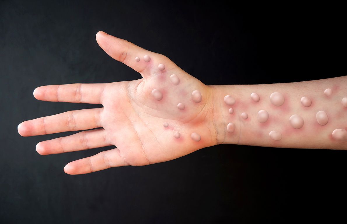 Kasus terkonfirmasi monkeypox atau cacar monyet tengah meningkat di berbagai negara di dunia. Yuk, simak cara mencegahnya!