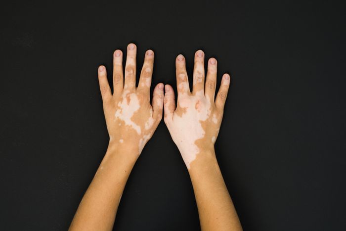 Contoh tangan penderita Vitiligo
