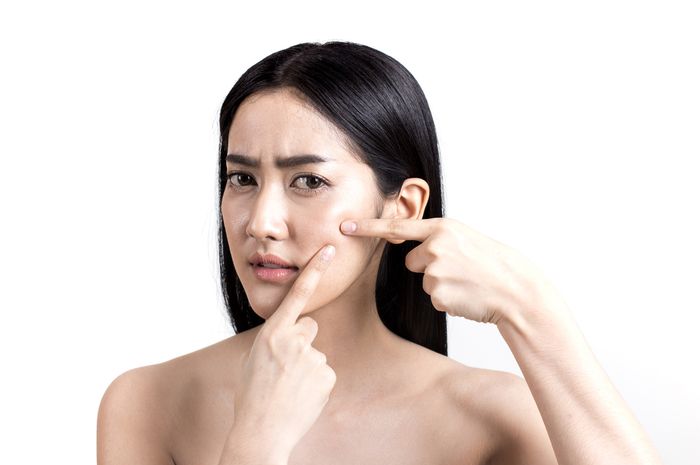 5 Kesalahan Pakai Acne Spot Treatment yang Sering Dilakukan, Apa Saja