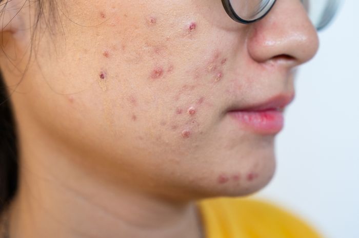 Apa Itu Acne Vulgaris Ketahui Tipe Jerawat Dan Berbagai Gejalanya Parapuan 